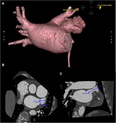 Case report: pulmonary artery perforation during transseptal puncture for left atrial appendage closure requires emergency cardiac operation